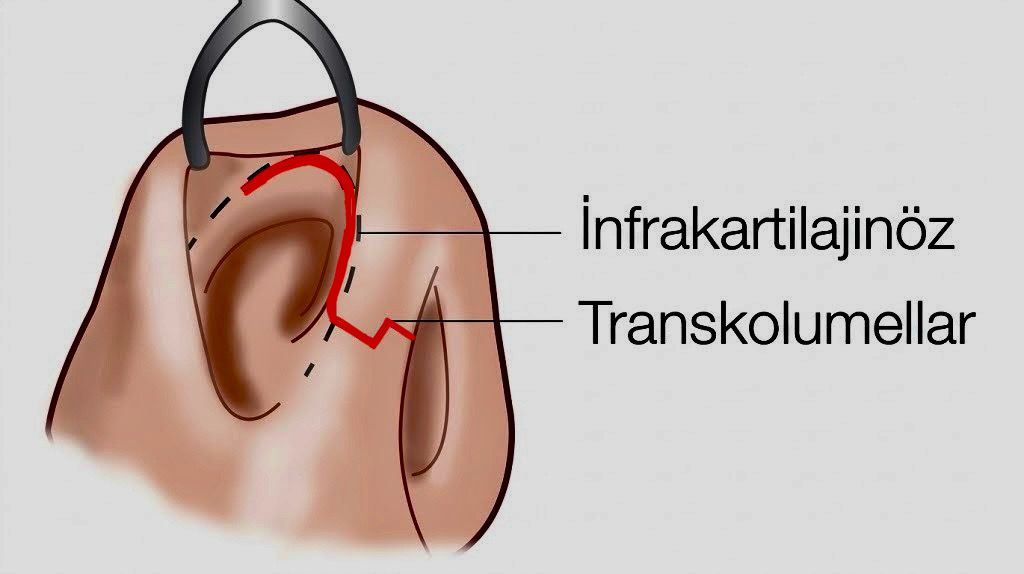 Açık Rinoplasti Open Rhinoplasty