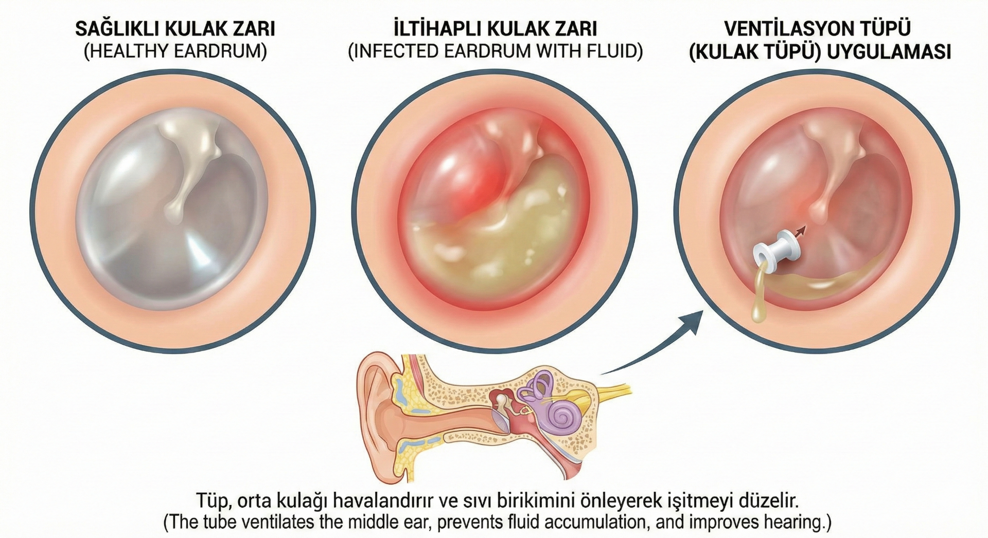 Kulak Tüpü Takılması Ventilasyon Tüpü Ameliyatı