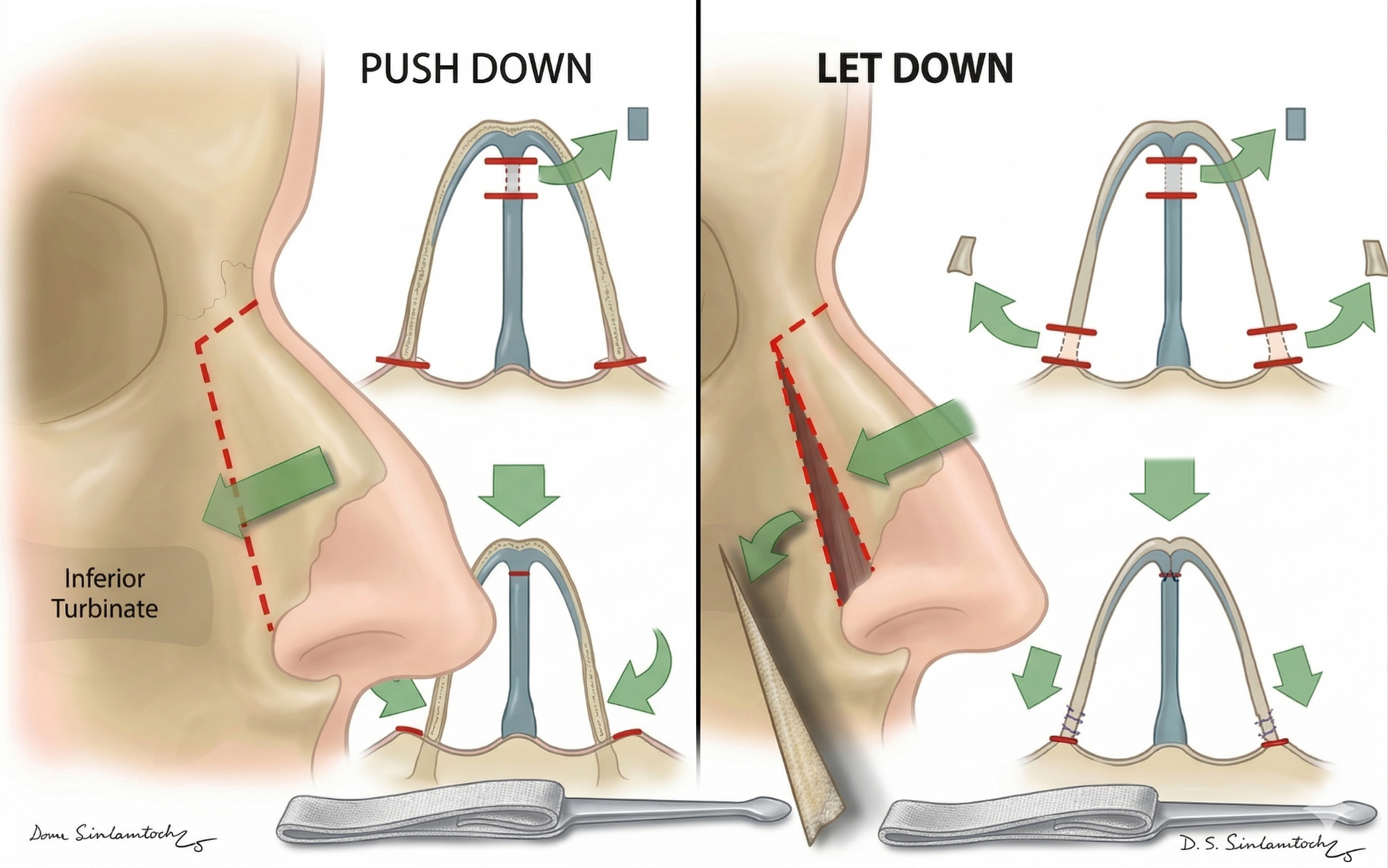 Push Down Rinoplasti vs Let Down Rinoplasti