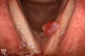 Ses Tellerinde Nodül ve Polip Cerrahisi